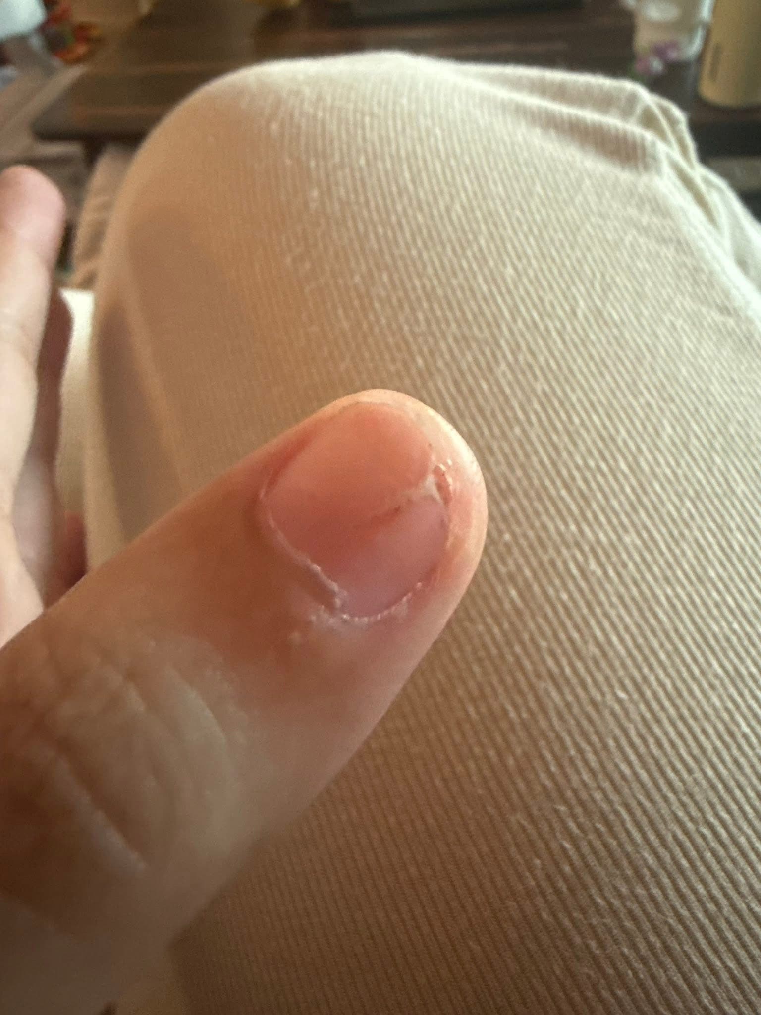 After - Nail Condition Improvement