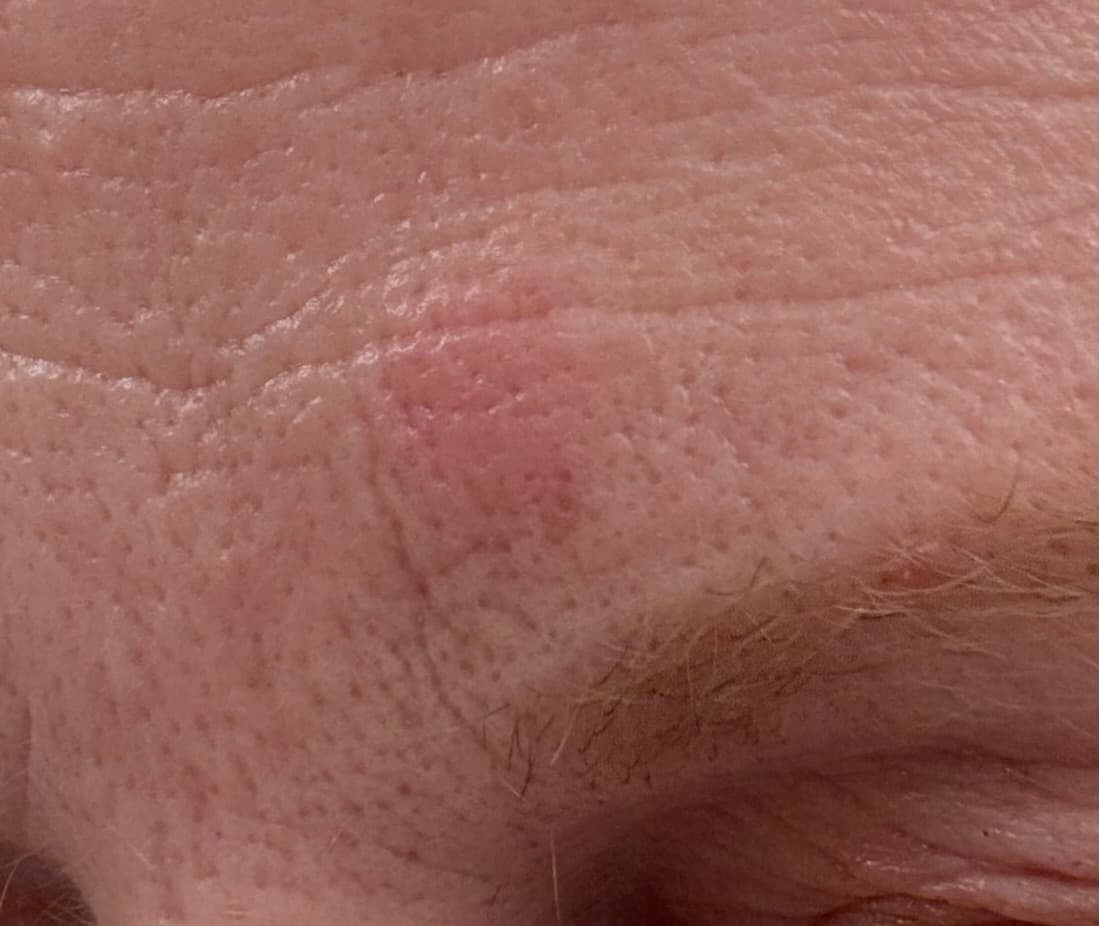 Before - Hand Skin Improvement